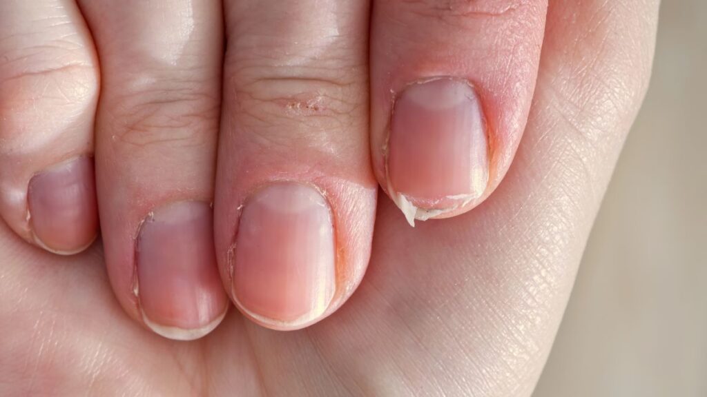 Brittle Nails